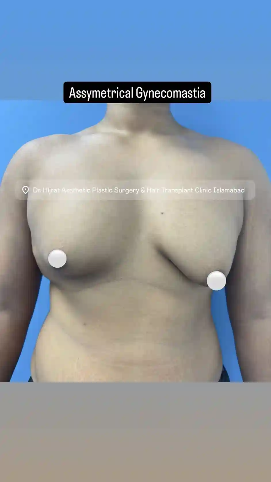 Before Gynecomastia Surgery